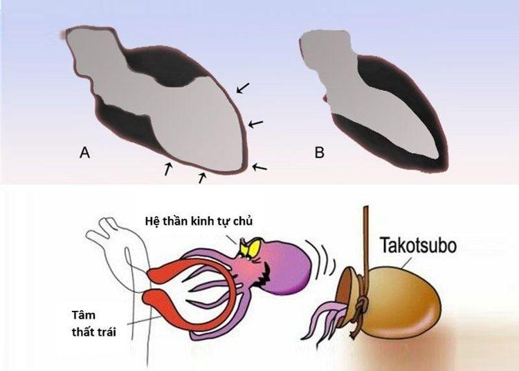 Figure 1. (A) Mỏm tim trái dãn rộng, phình lên giống chiếc bình trong bệnh Takotsubo so với (B) là bình thường