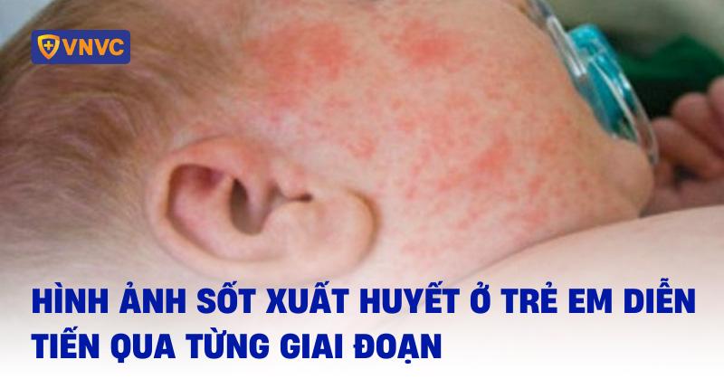 hình ảnh bệnh sốt xuất huyết ở trẻ em