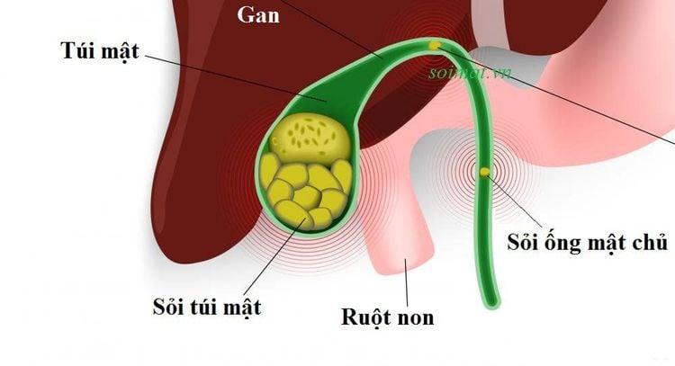 Sỏi ống mật chủ cần được phát hiện sớm và điều trị kịp thời