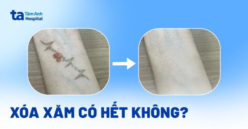 xóa xăm có hết không