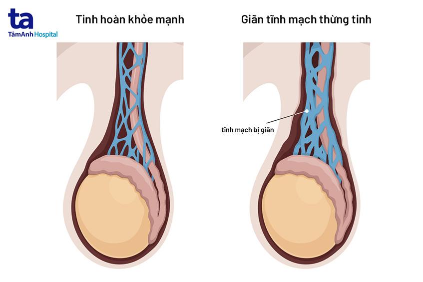 giãn tĩnh mạch thừng tin