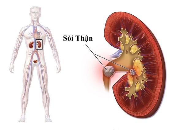 Hình ảnh mô tả sỏi thận trong hệ tiết niệu.