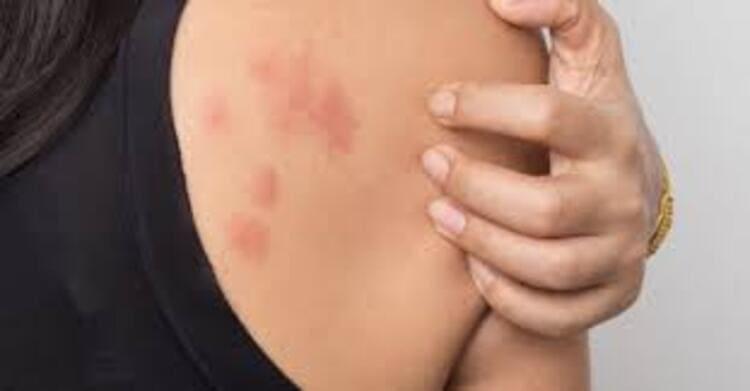 Da nổi mẩn đỏ do không vệ sinh vòi hoa sen