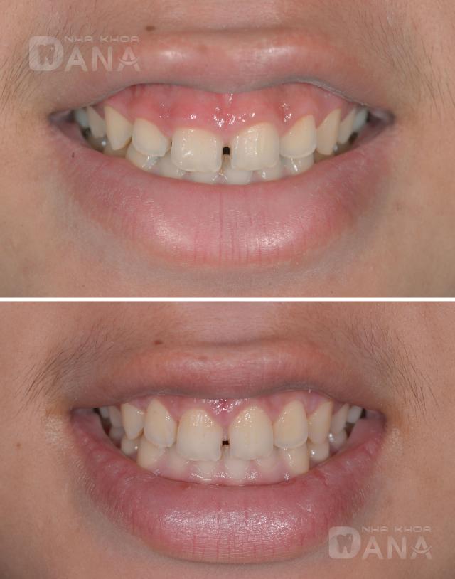 hình ảnh cắt nướu răng tại nha khoa dana